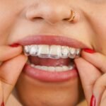 invisalign beverly hills