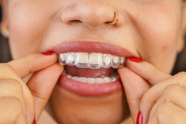 invisalign beverly hills