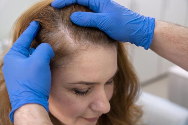 scalp micro pigmentation brisbane